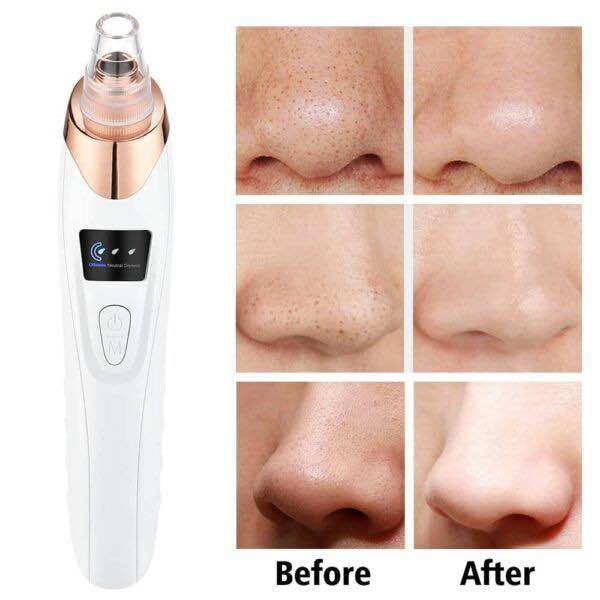 Electric Blackhead Remover & Pore Vacuum Cleaner